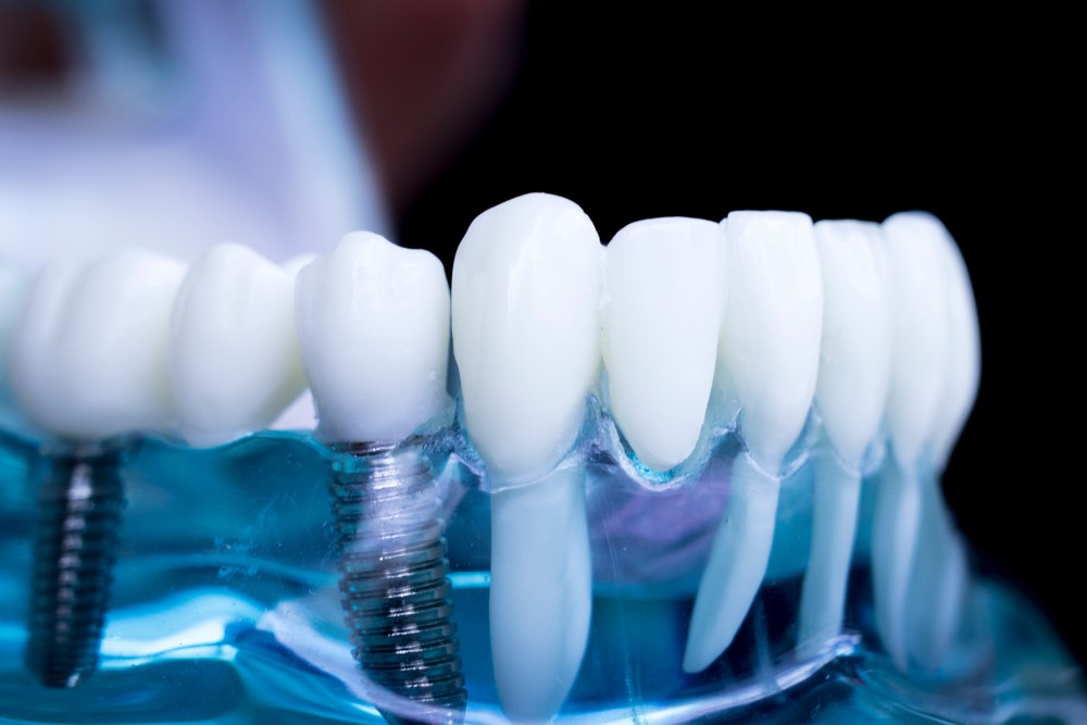 implantologie miercurea-ciuc, implant dentar miercurea-ciuc, clinica stomatologica timea orban